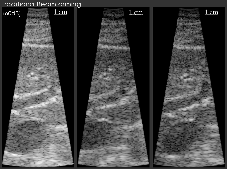 Traditional Beamforming on Gall Bladder